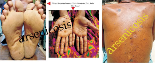 Effect of arsenic contamination - 1