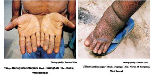 Effect of arsenic contamination